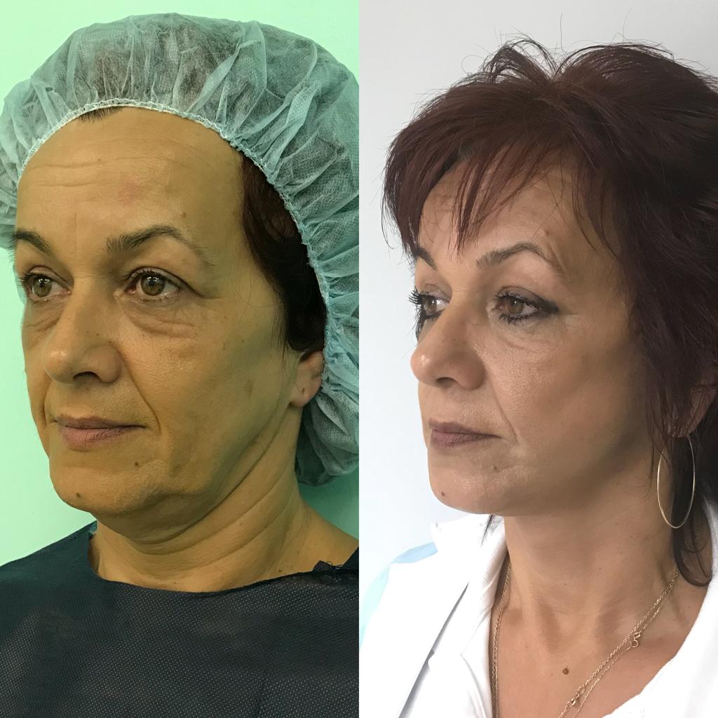 Barbora-Brezova-Facelift