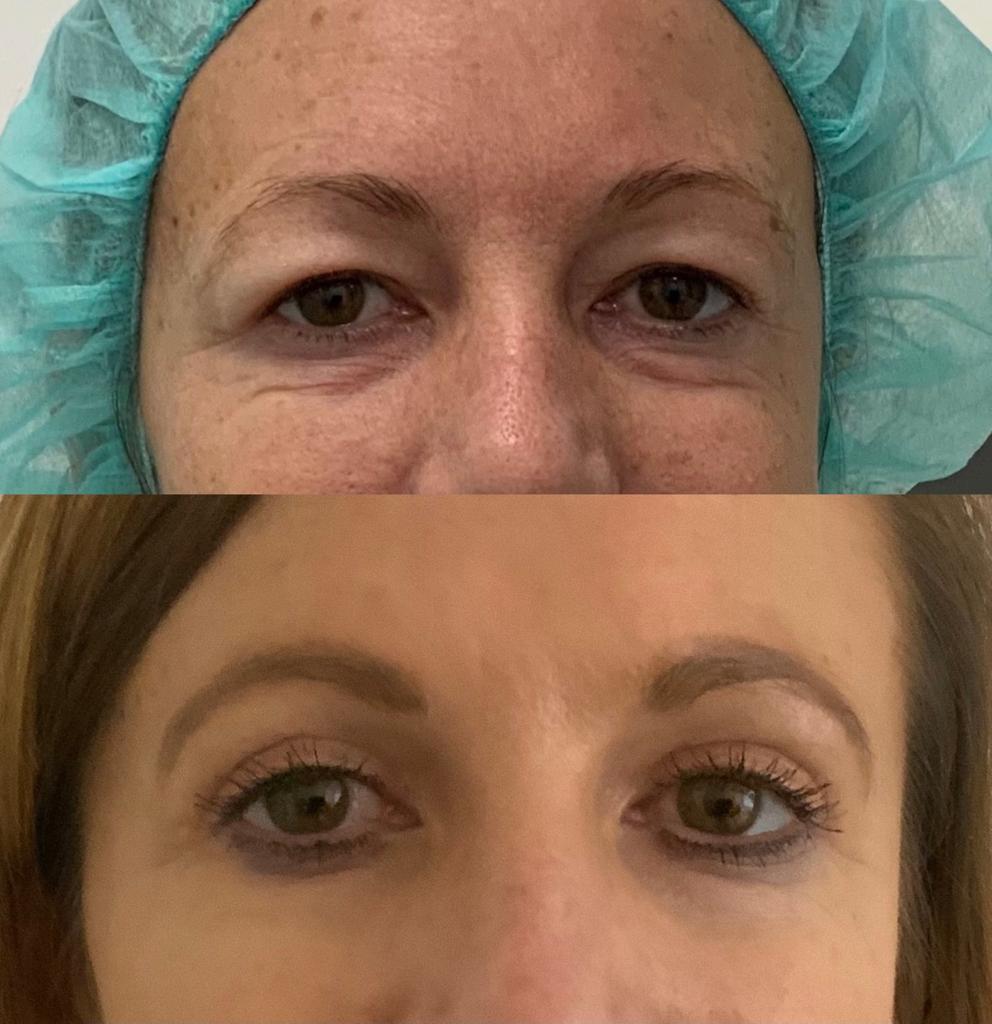 Barbora-Brezova-operacia-hornych-viecok-Blepharoplastika (1)